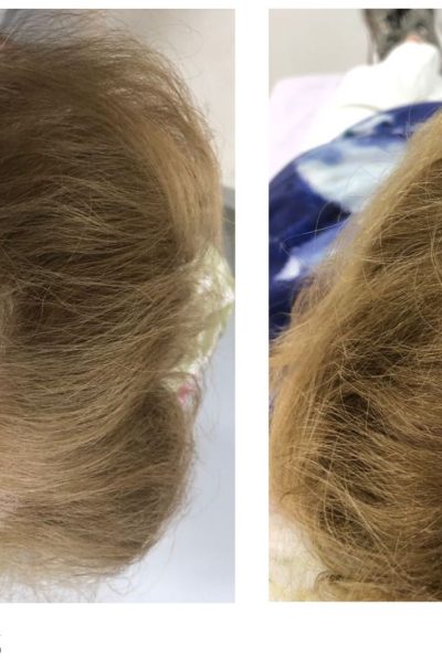 antesdespues capilar (1)